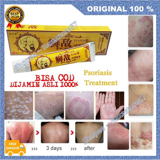 [BISA COD] Obat Herbal Cina Atasi Psoriasis Eksim Cream Psoriasis Ampuh ASLI