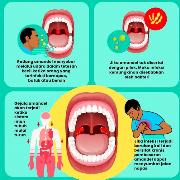 Obat Amandel Anak Dan Dewasa Ampuh Tanpa Operasi - Propolis Propotes 10ml