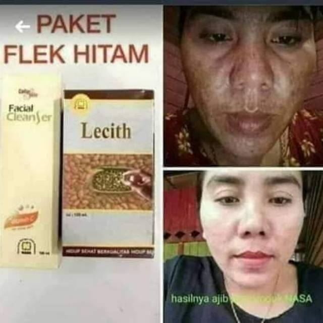 PROMO PAKET FLEK HITAM DAN PENGHILANG BOPENG HERBALIS NASA