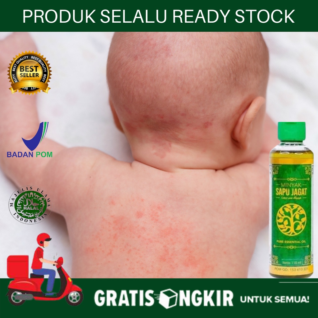 Obat Gatal Kulit Exsim Pada Bayi, Alergi pada Bayi & Anak, Gatal Iritasi, Bintik Merah Pada Bayi, Bi