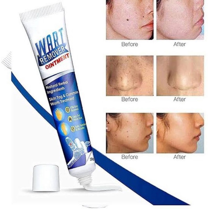 SKIN TAG REMOVER Menghilangkan Kutil Tahi Lalat Mata Ikan / SUMIFUN Wart Remover Ointment