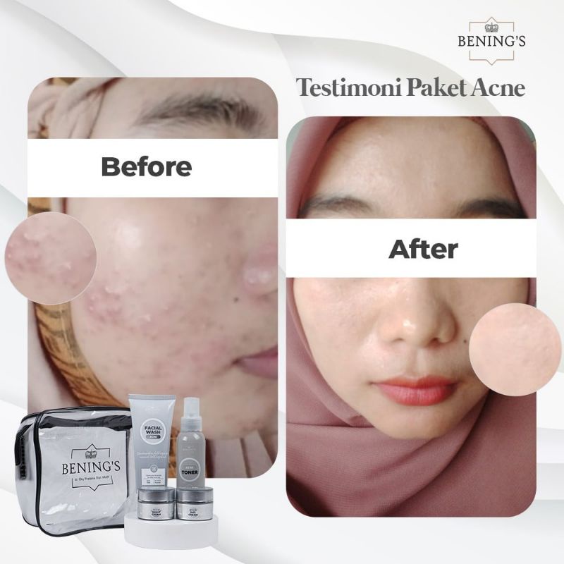 BENING SKINCARE DR OKY PRATAMA PAKET ACNE/BENINGS CLINIC/BENING SKINCARE/PAKET KECANTIKAN