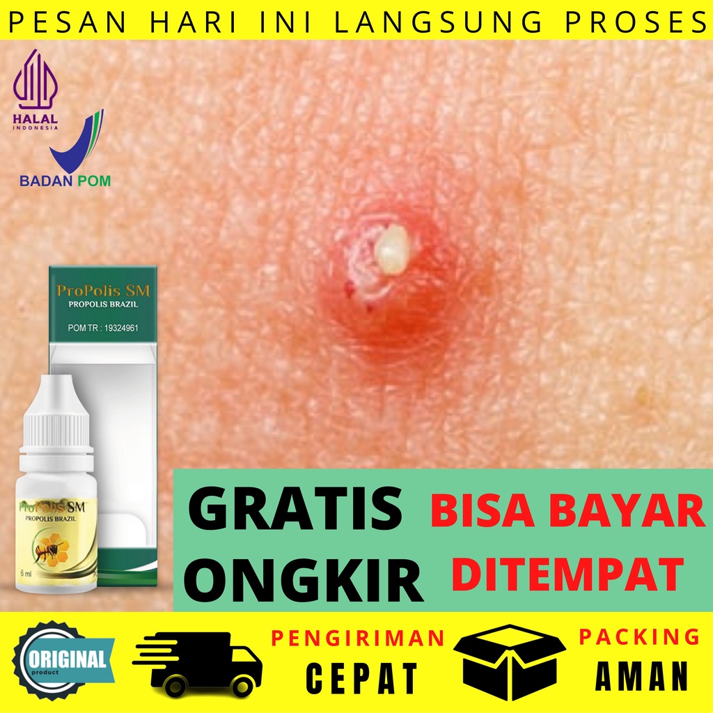 Obat Bisul Bernanah Furunkel Pada Kelamin Di Pantat Alami Benjolan Bintitan Kelopak Mata Pustula Tak