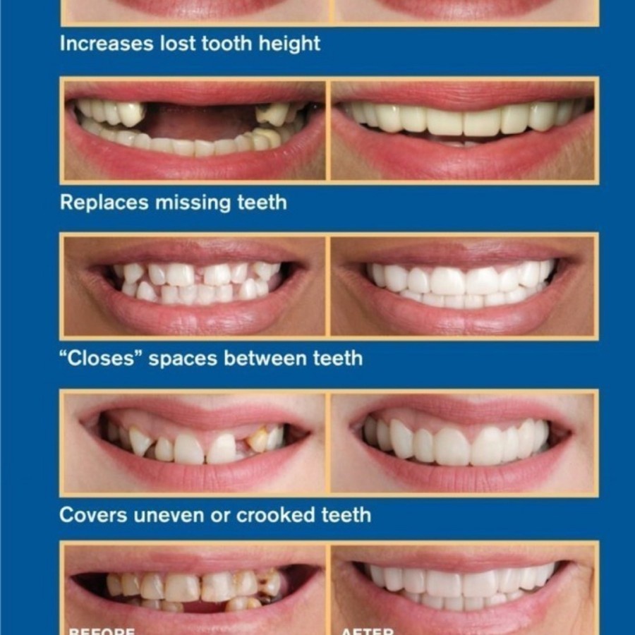 Snap On Smile Veneer Instan Gigi Palsu Tiruan Kesehatan Mulut Mouth Ok