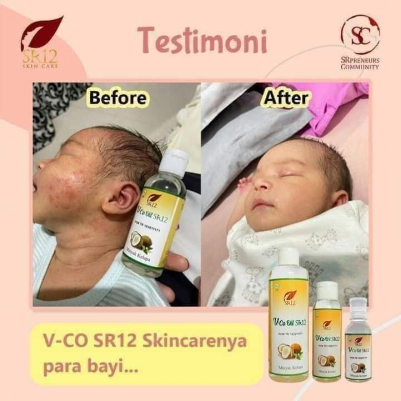 TERAMPUHH OBATI RUAM POPOK BAYI / IRITASI KULIT BAYI / RUAM ASI / MINYAK KELAPA SR12 / MINYAK KELAPA