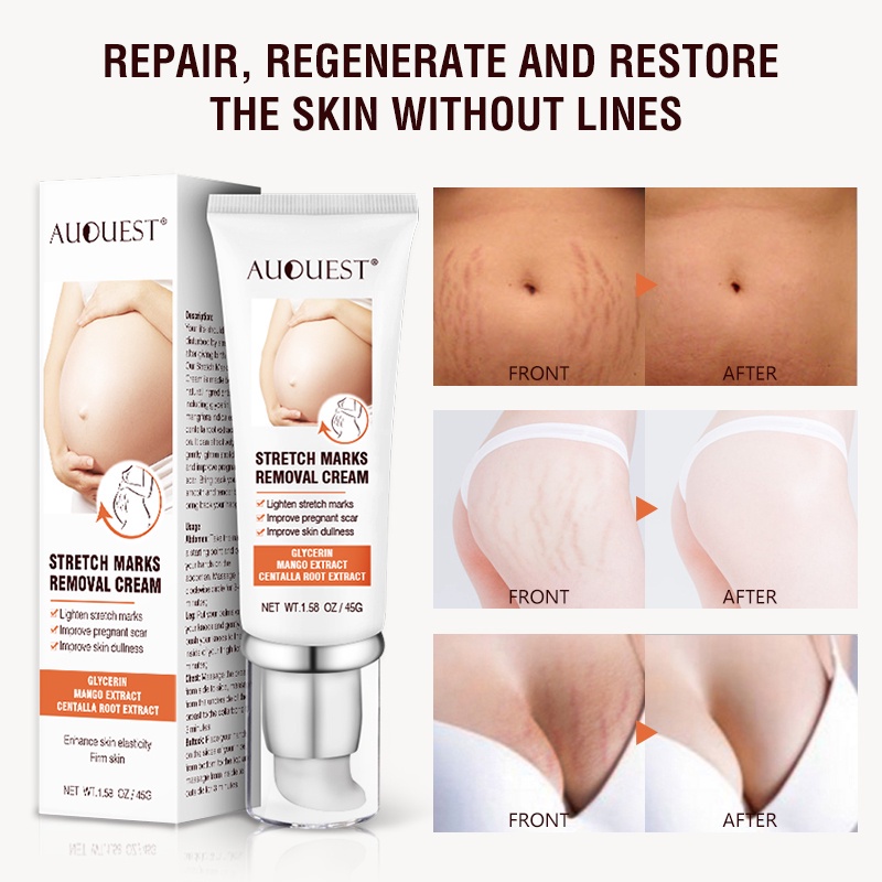 Penghilang strechmark  Strechmark cream Secara efektif menghilangkan stretch mark  Aman dan efektif