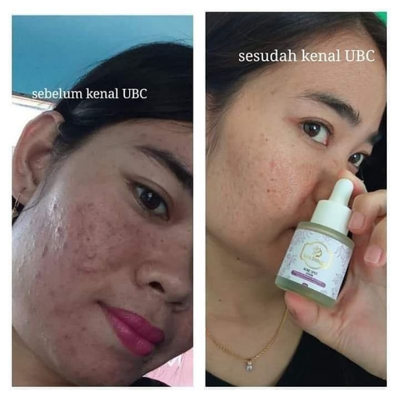 SERUM ACNE SERUM JERAWAT UBC ACNE SPOT SERUM BPOM