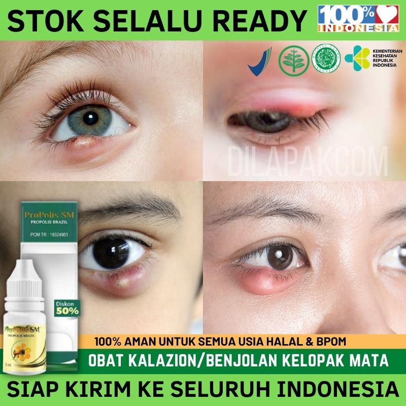 Obat Kalazion Mata, Obat Kalazion Benjolan di Mata, Obat Oles Obat Kalazion Propolis SM