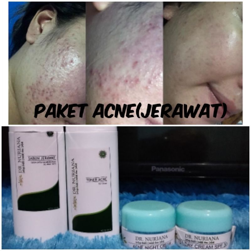 PAKET ACNE DR.NURIANA(jerawat parah)