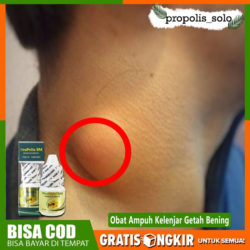 Obat Kelenjar Di Ketiak - Kelenjar Di Leher - Kelenjar Getah Bening - Propolis Sm Brazilian