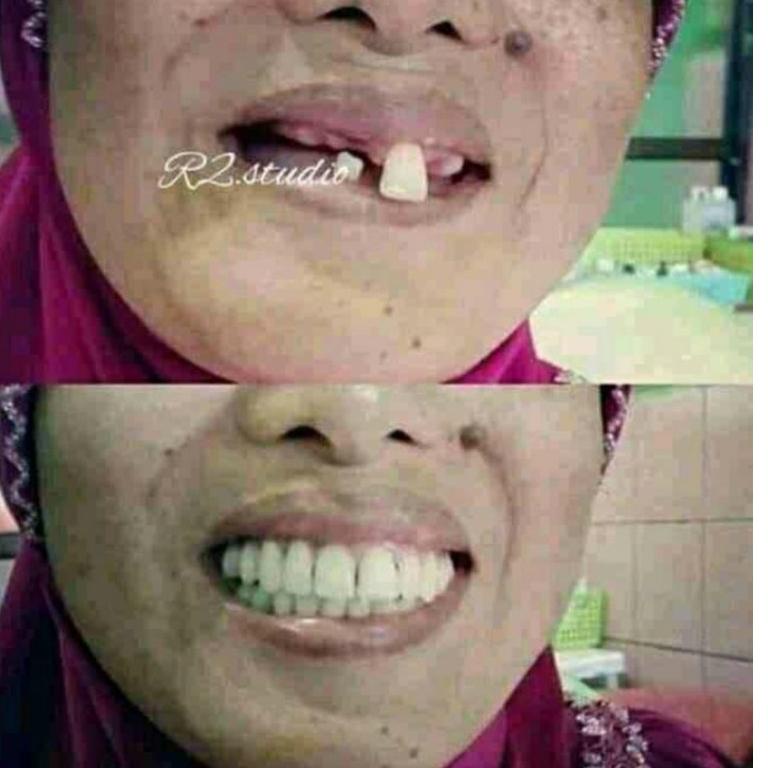 Terlaris ORECARE [ PENUMBUH GIGI, PENGHILANG KARANG GIGI DAN PEMUTIH GIGI ] A55D