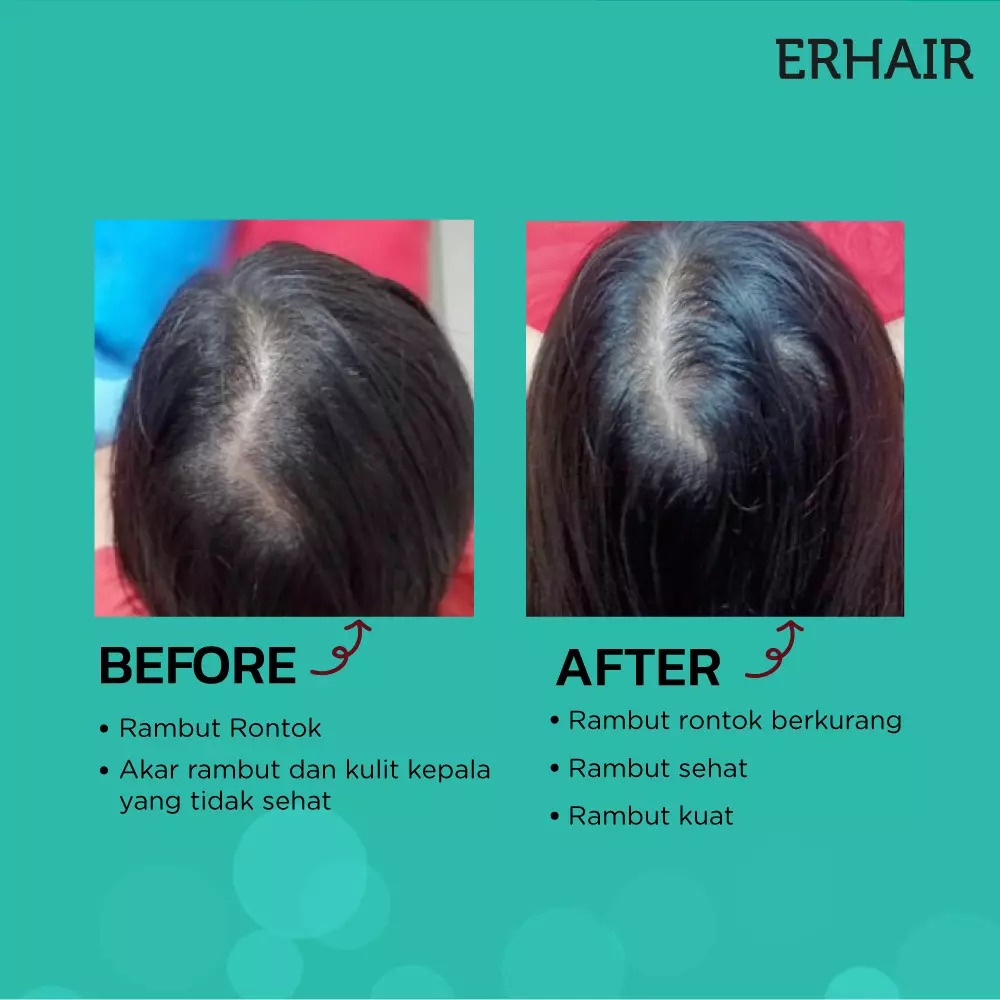 ERHAIR Hairgrow Serum 7 X 8 ML - Serum Penumbuh Rambut