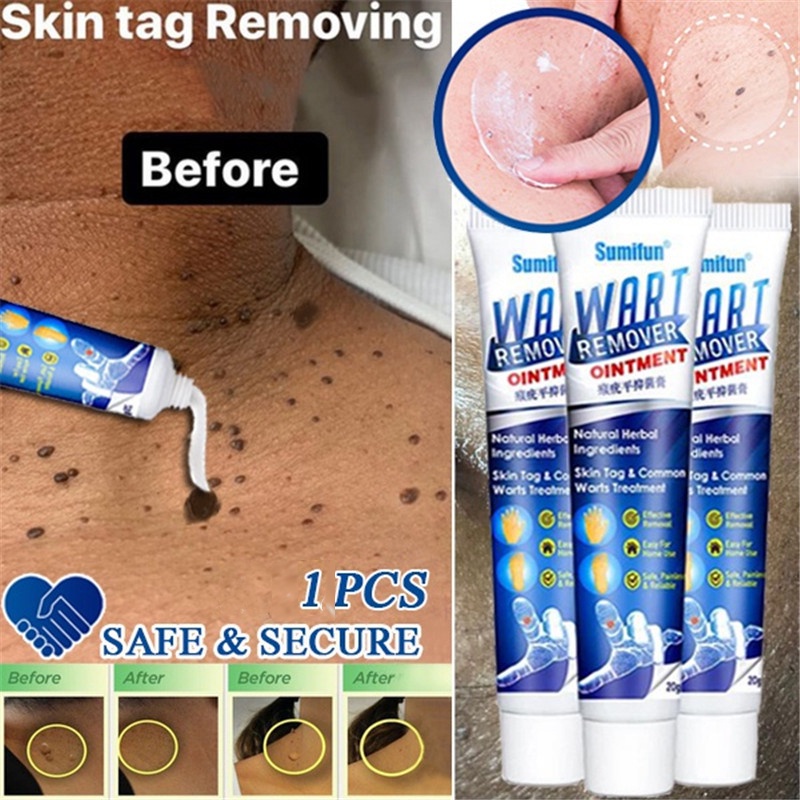 SKIN TAG REMOVER Menghilangkan Kutil Tahi Lalat Mata Ikan / SUMIFUN Wart Remover Ointment