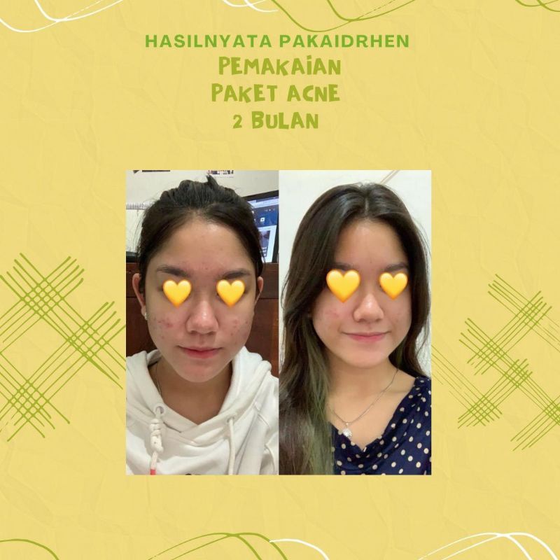 Dr Hen Skincare Original Paket Acne Whitening