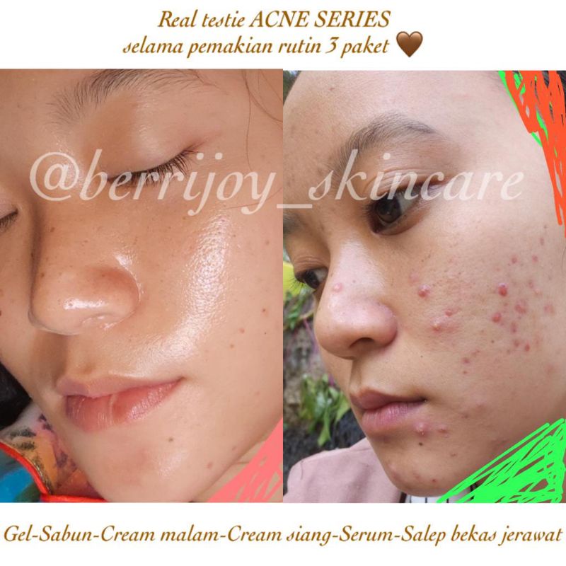 Gel Anti Acne