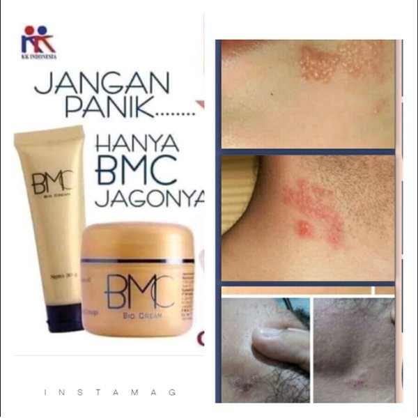 BMC (Bio Multiple Cream) Krim Luka Bakar Pegel Linu Bau Kaki KK Indonesia Paket Hemat 3 BOX