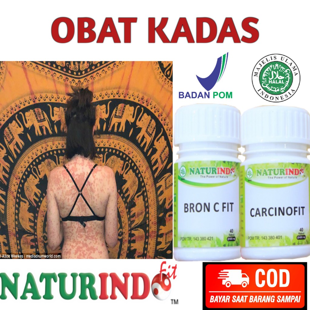 OBAT KADAS MENAHUN KURAP JAMUR KULIT HERBAL NATURINDO BISA COD