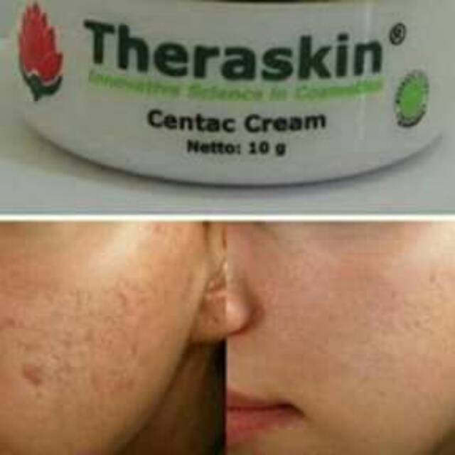 CENTAC CREAM || THERASKIN CENTAC CREAM || CREAM ANTI BOPENG || CREAM KHUSUS BOPENG || ORIGINAL