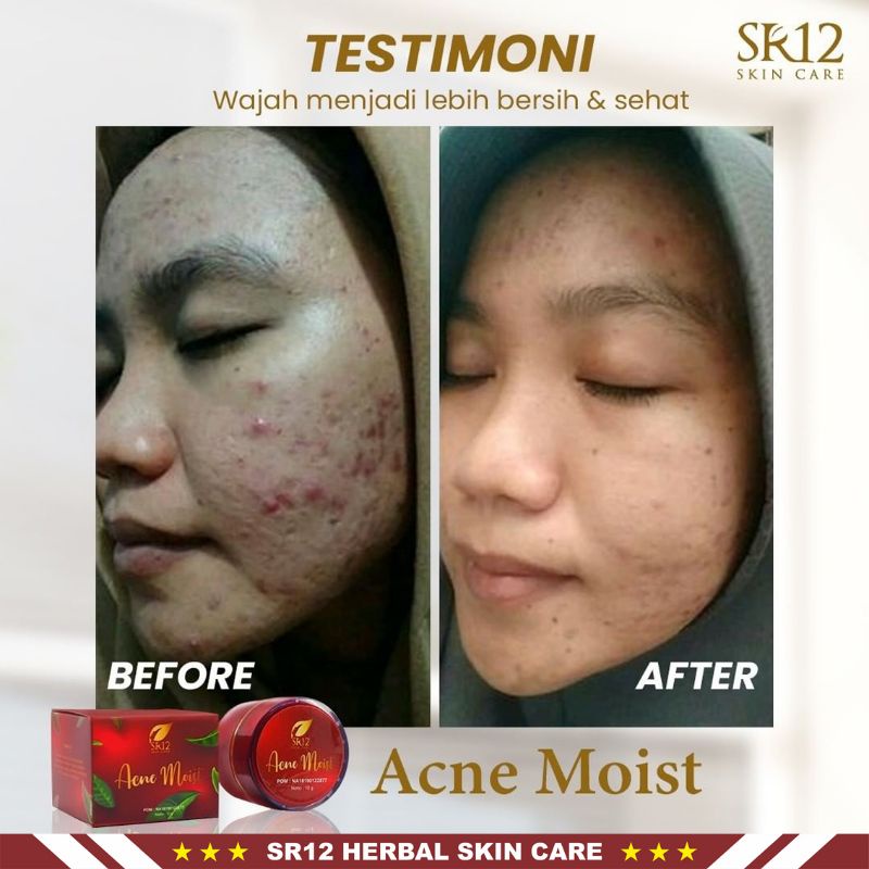 Skincare Wajah Berjerawat BPOM | Acne Series SR12 Skincare | Acne Moist | Acne Totol | Acne Serum | Acne Toner | Solusi Ampuh Atasi Jerawat | Menghilangkan Jerawat dan Bekas Jerawat | Krim Jerawat | Jerawat Bruntusan | Jerawat Batu | Jerawat Membandel