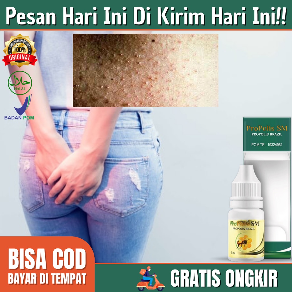 Jual Obat Pantat Gatal Bruntusan Beruntusan Obat Atasi Pantat Hitam Burik Dan Nyeri Terlaris