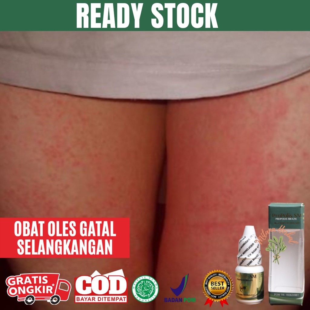 MIAL Salep Gatal Selangkangan, Obat Gatel Selangkangan, Krim Selangkangan, Salap Gatal Selangkangan 