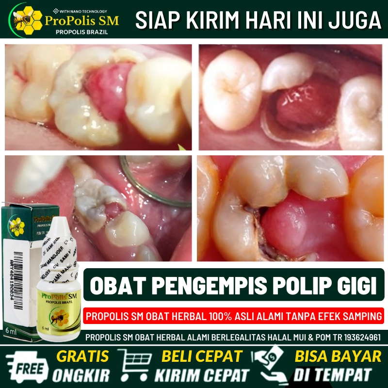 Obat Tetes Polip Gigi 100% Alami, Obat Polip Gigi Anak, Obat Polip Gigi Dewasa, Pengempis Polip Gigi