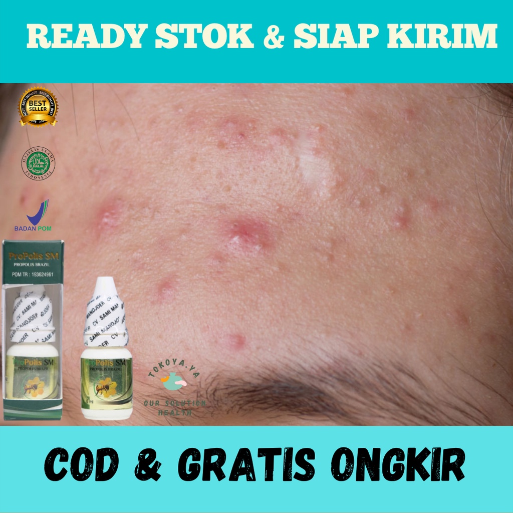 Obat Herbal Bruntusan Kecil Kecil Di Jidat, Obat Herbal Pembersih Bruntusan di Jidat, Obat Herbal Pe