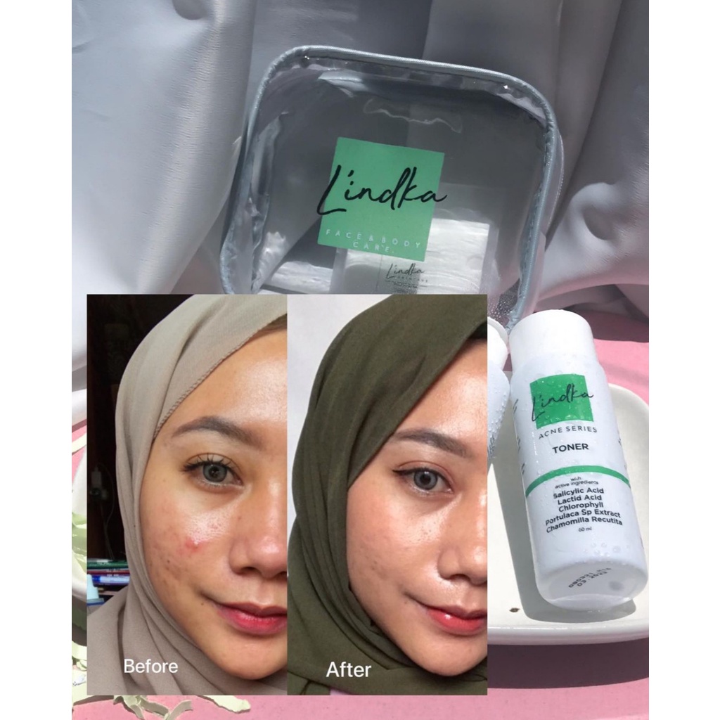 [PAKET JERAWAT] L'indka Acne Series Set (Day Cream &amp; Night Serum Gel &amp; Facial Wash &amp; Toner) Lindka Skincare BPOM Halal