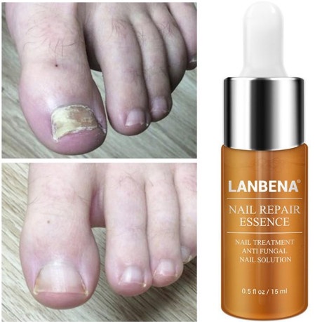 Obat Menghilangkan Jamur Kuku