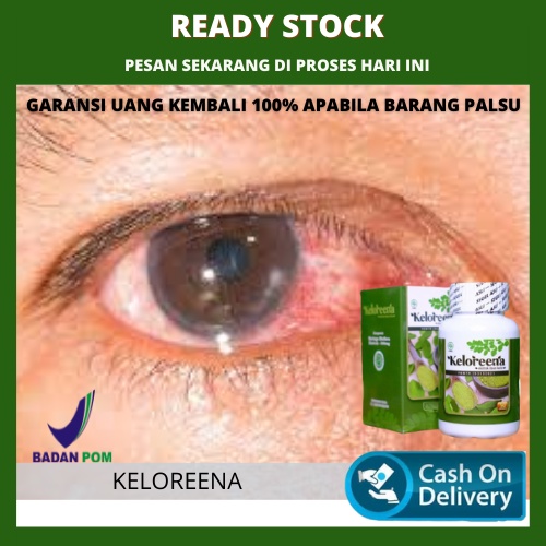 Obat Ulkus Kornea, Mata Gatal Berair, Luka Kornea Mata, Bintik Putih Kornea Mata, Mata Merah, Pandan