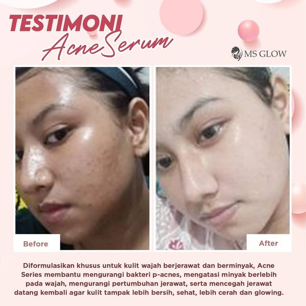 Ms Glow Acne Serum Ms Glow Original 100% Serum Acne Jerawat Beruntus Ms Glow