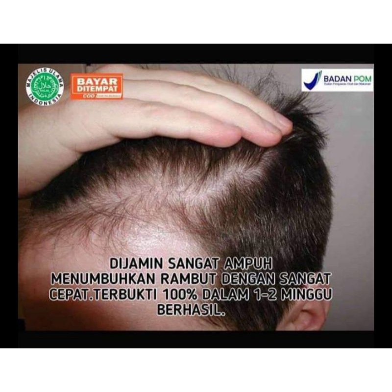 

pembasmii kutil/taii lalat sangat ampuh
