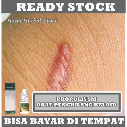 Obat Penghilang Keloid - Obat Uci uci - Obat Skin Tag - Obat Perontok Kutil - Obat Pengempis Daging Jadi - Obat Mata Ikan - Obat Kutil di Leher - Obat Kutil di Kelopak Mata - Obat Kutil di Wajah / Tubuh - Obat Penghancur Daging Tumbuh Dengan Propolis SM