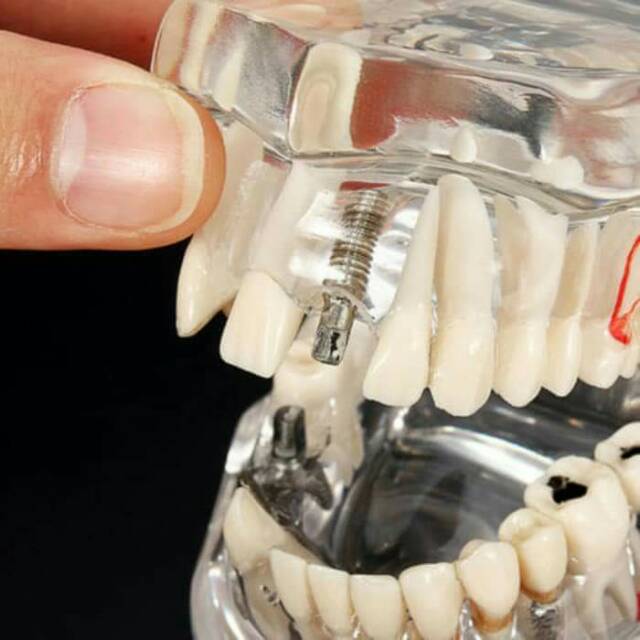 Dental study model caries impacted teeth crown bridge implan patung gigi