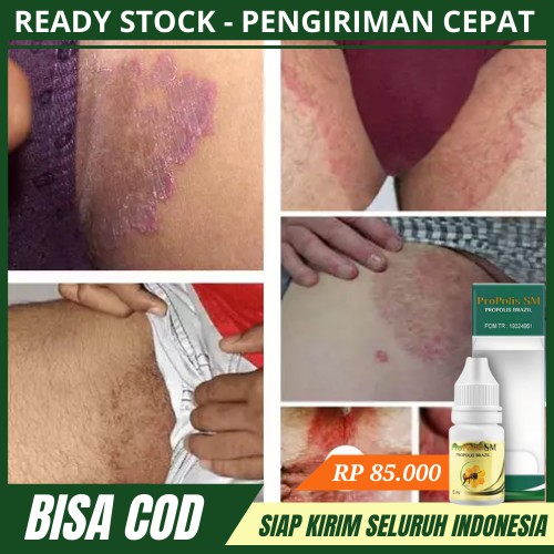 Obat Gatal Gatal Pada Selangkangan - Penghilang Jamur Diselangkangan Dengan Propolis SM