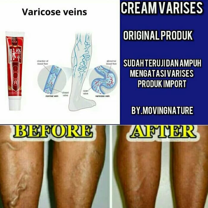 Meilibahenling Miss Moter Macha Ped Egg Power Obat Varises Cream Kaki Varises Varicos Veins Shopee Indonesia