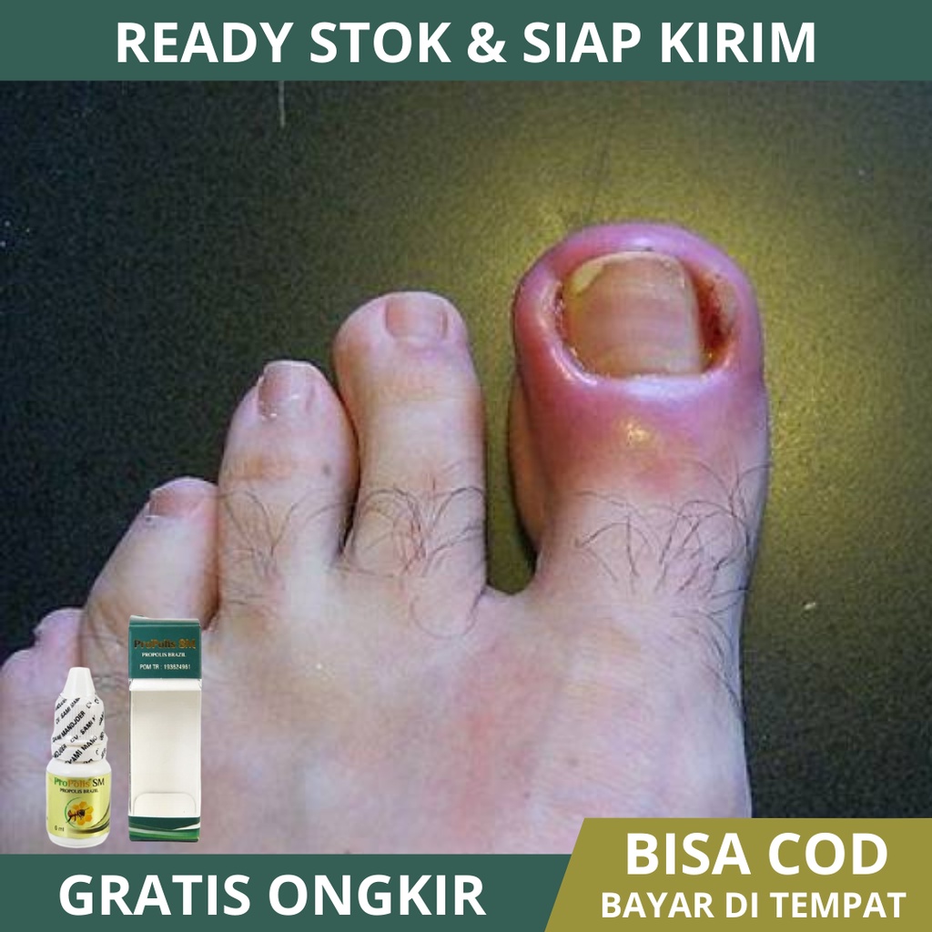 Obat Cantengan Jempol Kaki, Cantengan Tangan, Cantengan Parah, Cantengan Kaki, Kuku Cantengan, Kuku 