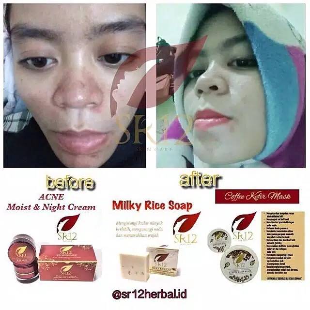 ACNE MOIST SR12 / ATASI JERAWAT