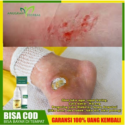 Ekstrak propolis brazilian - Obat luka agar cepat kering, Luka bakar, Koreng, Pengering Luka Diabete