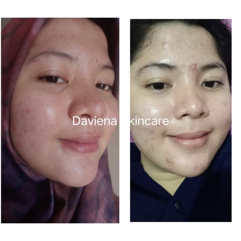 [Official] ACNE SERIES|CREAM JERAWAT AMPUH BPOM DAVIENA SKINCARE|Daviena Skincare