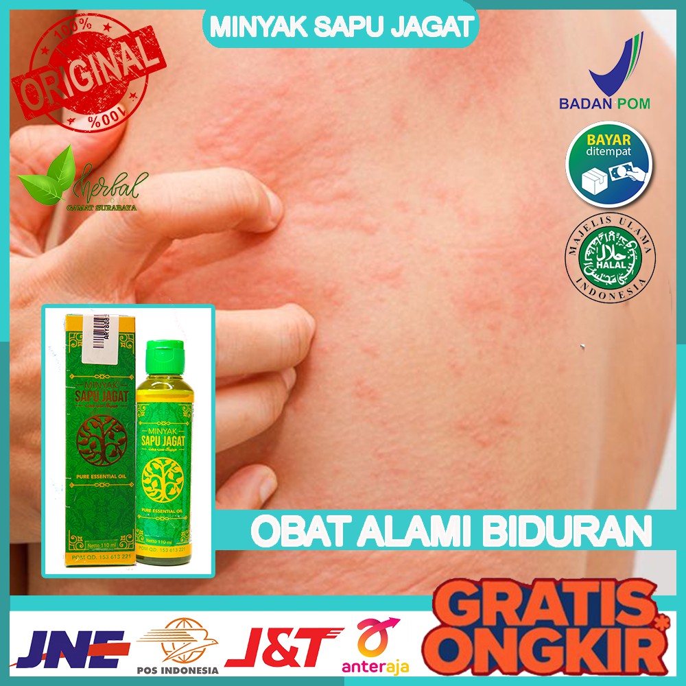 Jual Obat Biduran Gatal Gatal Ruam Merah Alergi Makanan Minyak