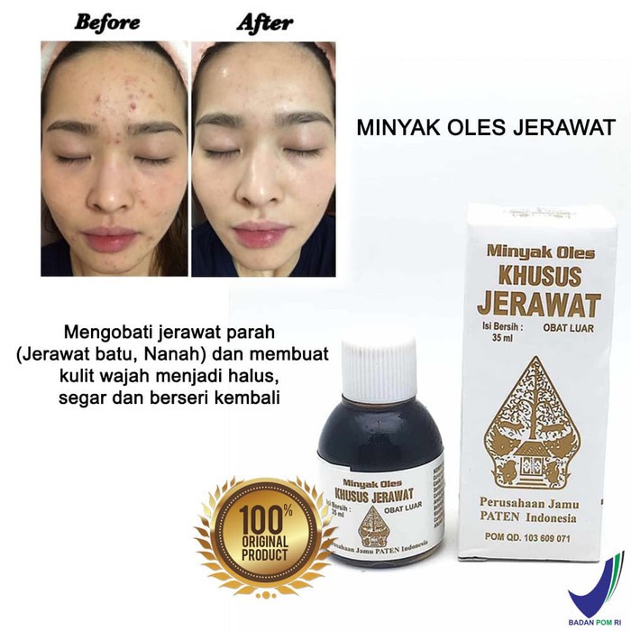 AJ Mart - BPOM Minyak Oles Khusus Jerawat, Obat Jerawat Wayang