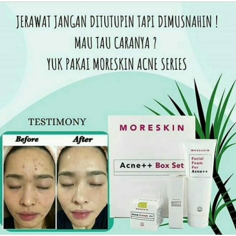 Moreskin Acne Series Nasa(untuk jerawat)