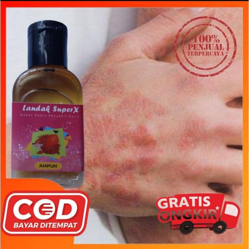 Obat Eksim Kering Menahun Gatal Kulit