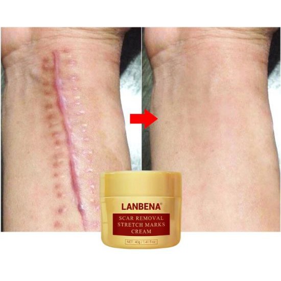 Lanbena Scar Removal Stretch Marks Cream - Penghilang Bekas Luka