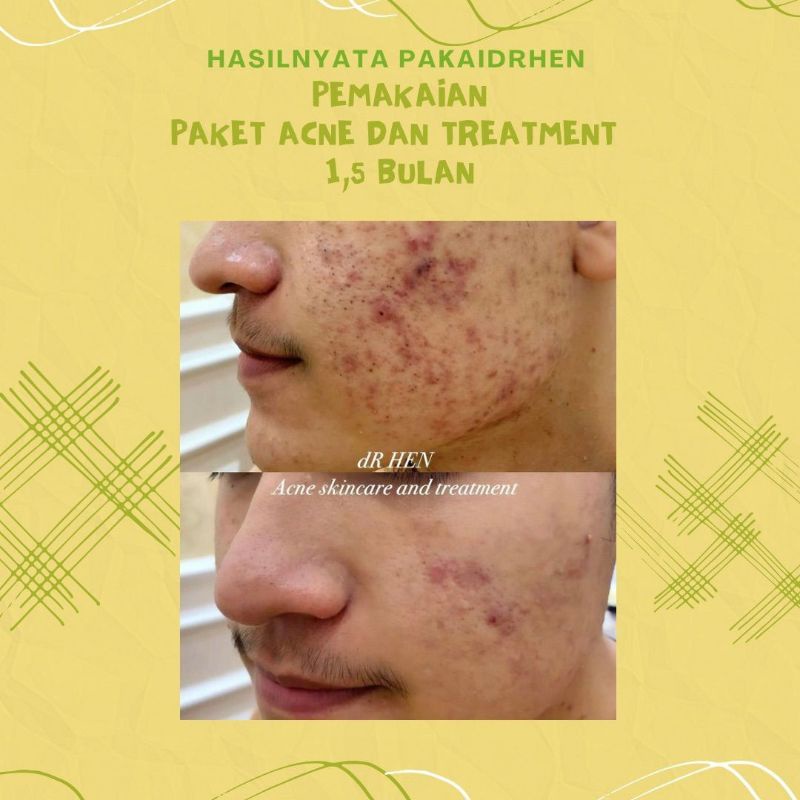 Dr Hen Skincare Original Paket Acne Whitening