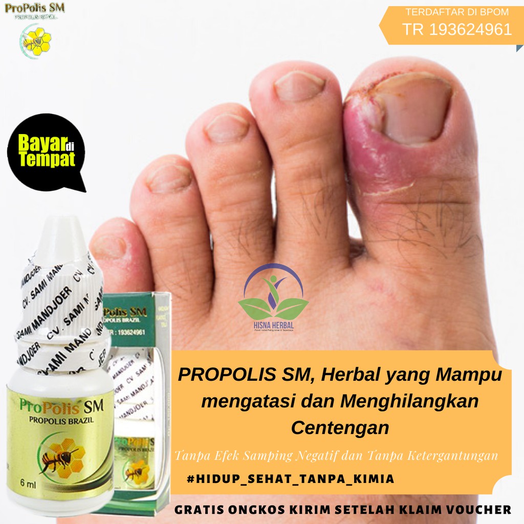 Obat Sakit Jempol Kaki Berdarah Dan Bau Busuk Propolis Sm 100 Mengobati Tanpa Efek Samping Bisa Cod Shopee Indonesia