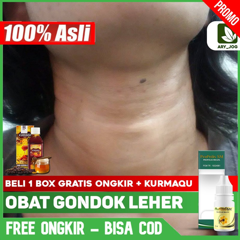 

Obat Gondok Beracun, Tyroid, Tiroid Benjolan Di Leher Alami Herbal PROPOLIS SM Yogyakarta Bisa COD