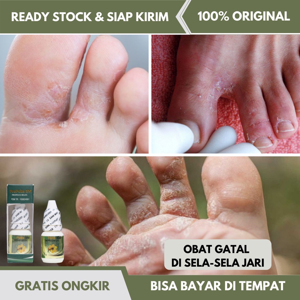 Obat Gatal Di Sela Jari Kaki - Obat Rangen Di Kaki - Obat Kutu Air Pada Kaki - Obat Infeksi Jamur Di