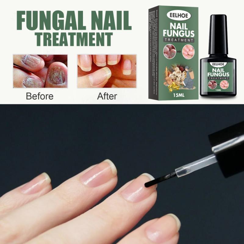 NAIL FUNGUS TREATMENT 15ML OBAT JAMUR KUKU BY EELHOE